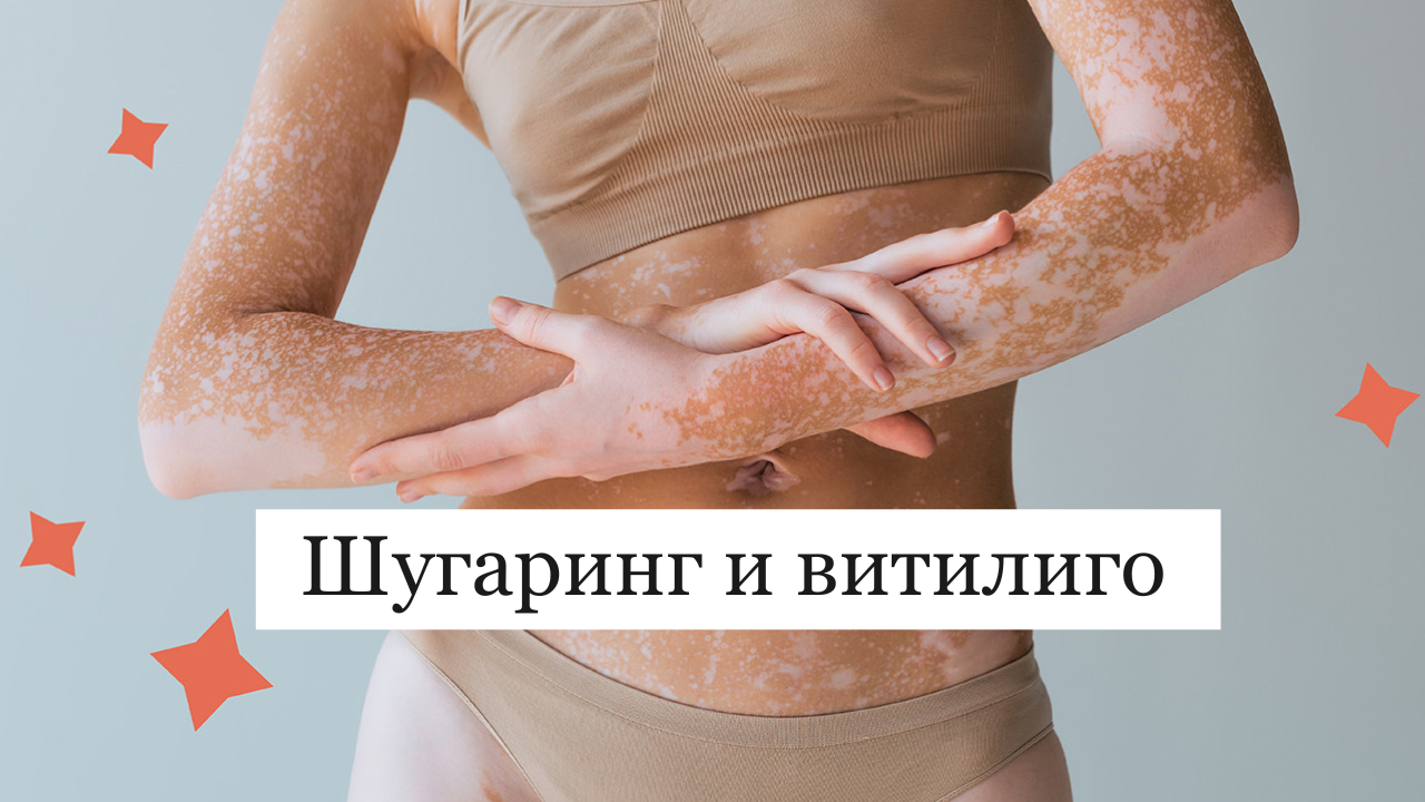 Шугаринг и витилиго