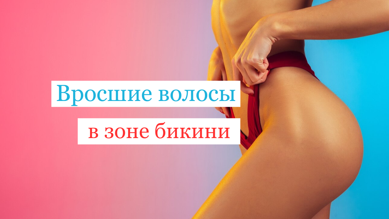 Лечение вросших волос в зоне бикини